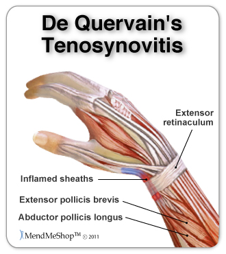 De Quervain S Syndrome Overview Symptoms Causes Treatments