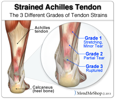 Achilles Tendon strain or sprain, which is affecting 