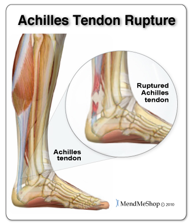 Some people might have Achilles tendonitis but think they have foot tendonitis