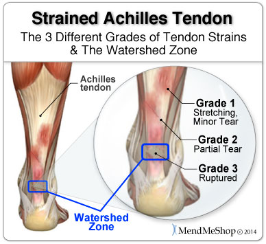 The Achilles tendon watershed zone is 2 to 4 cm above the heel bone.