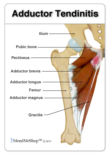 Adductor Tendonitis