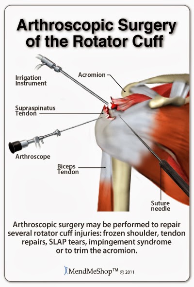 Arthroscopic surgery for a supraspinatus tendon rotator cuff tear.