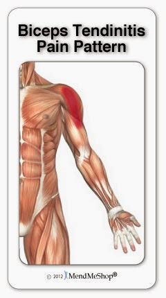 Bicipital Tendinitis Pain Pattern