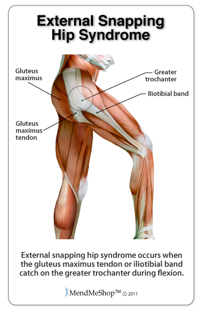 Snapping hip syndrome