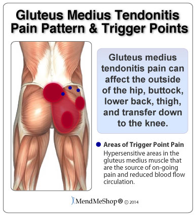 Gluteus muscle Strain: Gluteal Muscle pain & buttock pain - Physio