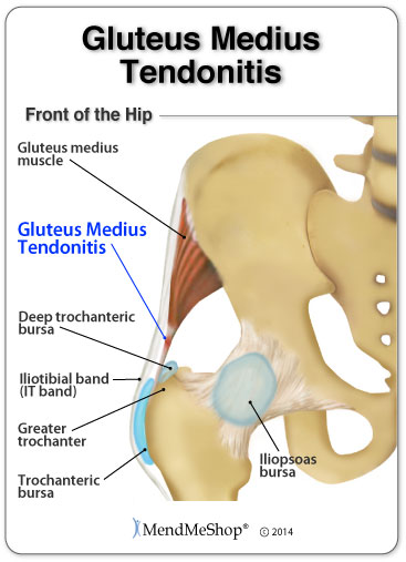 Gluteus medius tendonitis is irritation and inflammation of the tendon fibers.