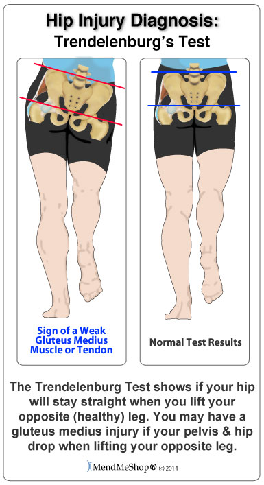 The Trendelenburg test should if your hip will stay straight when you lift your healthy leg.