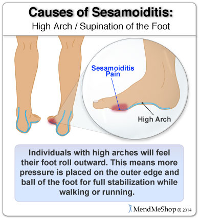 With high arches more pressure is placed on the outer edge and ball of the foot.