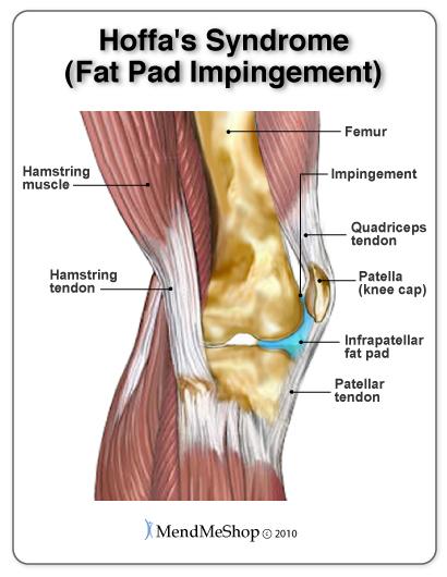 knee impingement hoffas syndrome