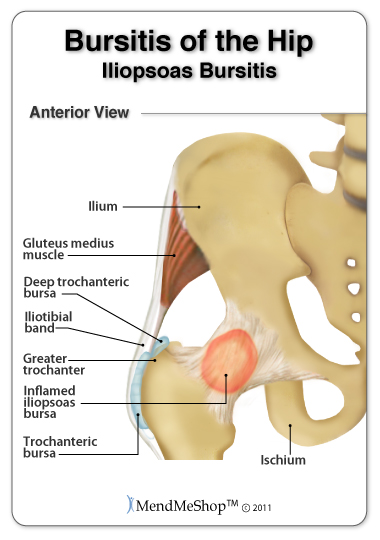 Iliopsoas bursitis is often found in conjunction with iliopsoas tendinitis