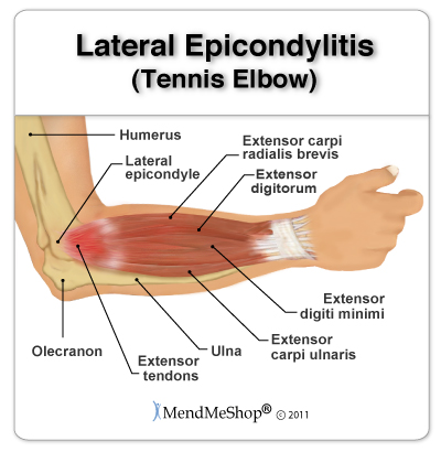 tennis elbow anatomical image