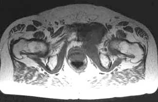 Adductor Longus Groin