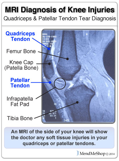 Patellar Tendon Rupture River Forest