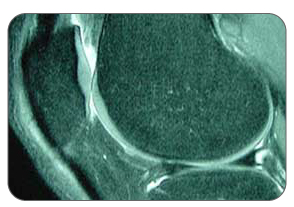 pes anserine knee mri