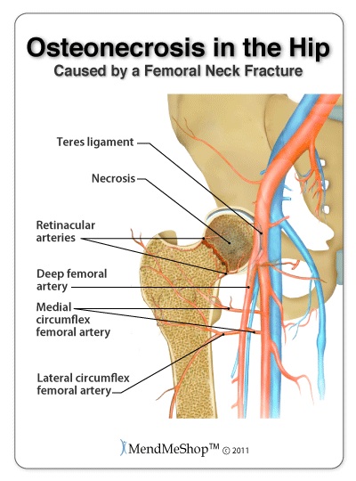 hip pain and Osteonecrosis