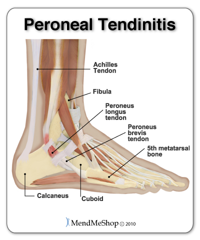 Peroneal Tendonitis