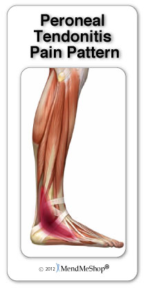 Peroneal Tendonitis pain pattern