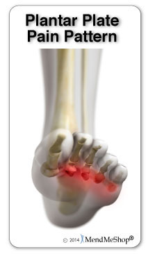 Where you feel plantar plate pain in your foot.