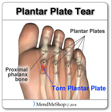 Painful plantar plate tears TShellz Wrap<sup>®</sup> home treatment