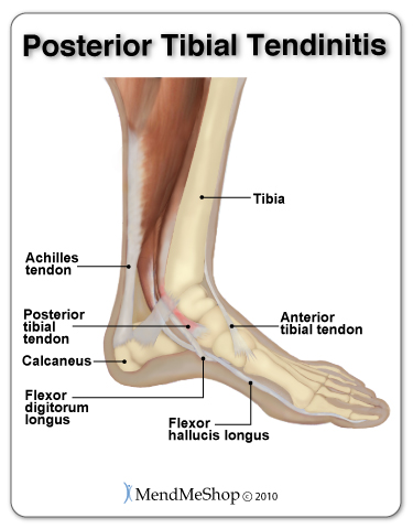 Posterior tibial tendonitis/tendinitis.