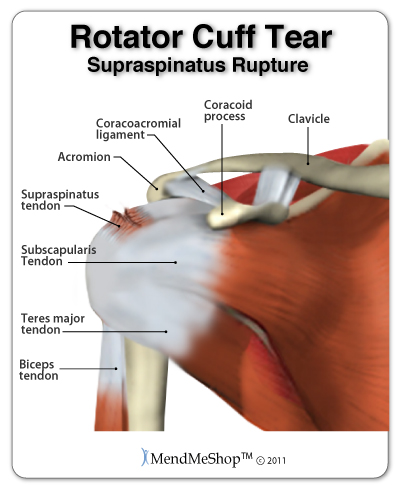 Subscapularis Muscle Tear   Rotator Cuff Supraspinatus Tendon Tear 