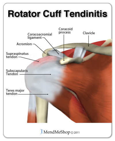 Shoulder Tendinitis
