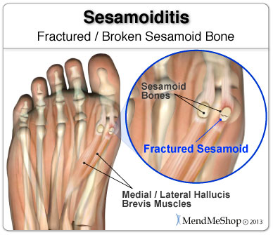 Sesamoiditis can sometimes involve a break or fracture to your sesamoid bone.