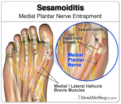 Sometimes sesamoiditis pain is a nerve entrapment injury.