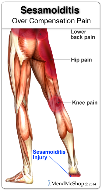 Long-term limping or shuffling with a sesamoiditis injury may lead to pain in the knee, hip and/or lower back.