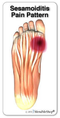 Sesamoiditis will usually present with pain in the ball of the foot.