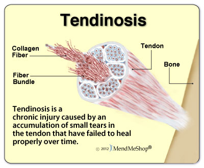 Tendinosis Injured Tendon Pain