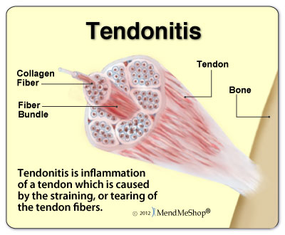 Tendonitis is fraying of the tendon fibers from injury or over-use