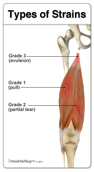 groin muscle pain can be minor to severe.