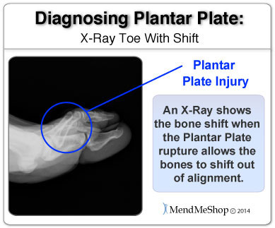 plantar plate rupture Xray
