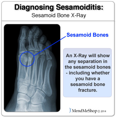 An x-ray will clearly show the sesamoid bones and any separation or fracture in those bones.